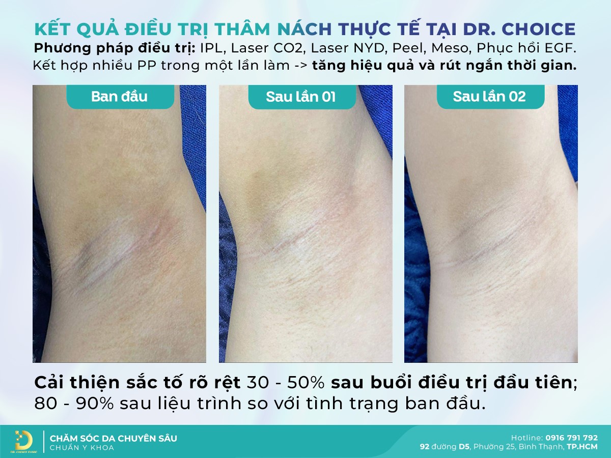 Đánh Giá Hiệu Quả Điều Trị Thâm Nách/ Bẹn Tại Dr Choice Clinic 40
